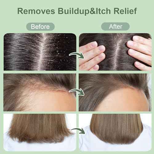 Scalp Scrub, Rosemary & Mint Oil & Biotin Scalp Exfoliator Scrub Shampoo with Silicone Cleansing Massager, Hair Treatment for Itchy Scalp, Dandruff & Buildup Removal & Thick and Strong Hair Growth