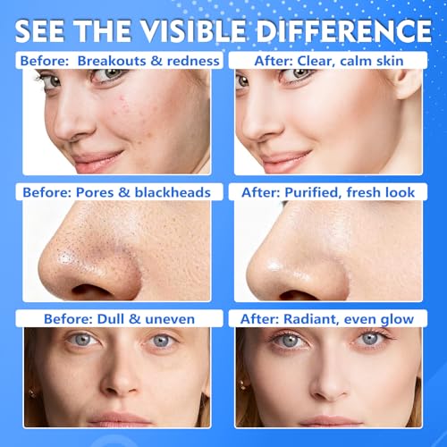 Tiepetly Glycolic Acid Pads (60 Count), 20% Ultra Pure Glycolic + 2% Salicylic Acid, Exfoliating Pads Resurfacing with Vitamin C&E, Deep Cleaning for Face and Body