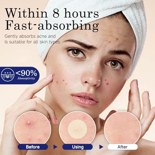 Acne Pimple Patches - 4 Sizes, 220 Count, Hydrocolloid Formula