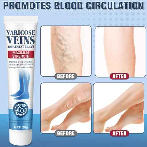 Varicose Veins Treatment for Legs, Varicose Veins Cream, Gentle Moisturizing, Solve Leg Heaviness and Swelling, Improve Circulation 20 g