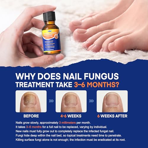 Toenail Fungus Treatment 25% Undecylenic Acid Extra Strength