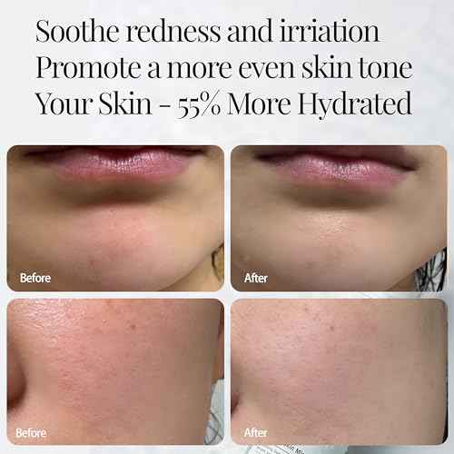 CICA Aloe Hydrating Toner Spray for Face - pH Balanced Facial Mist - Aloe Vera and Centella Asiatica - for Acne Prone and Sensitive Skin - Korean Skincare for Redness, Dryness