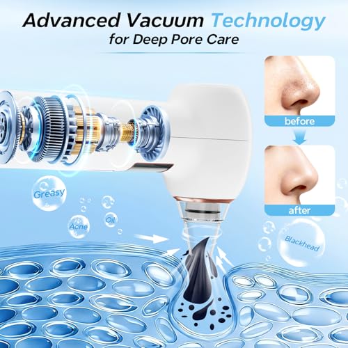 Mylzdobs Blackhead Remover with 3 Modes & 5 Suction Heads