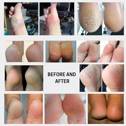 Instant Feet Callus Remover Spray - Quick Peeling Formula, 100ml