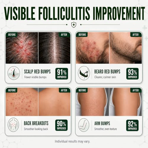 Eoiroa Folliculitis Cream for Scalp & Body Bumps - Fast-Acting Acne & Razor Bump Treatment, 3.5 oz