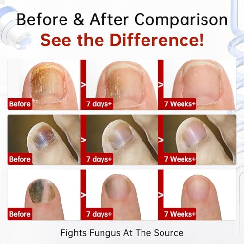 Tolnaftate 1% Antifungal Nail Treatment - Thick Discolored Nails