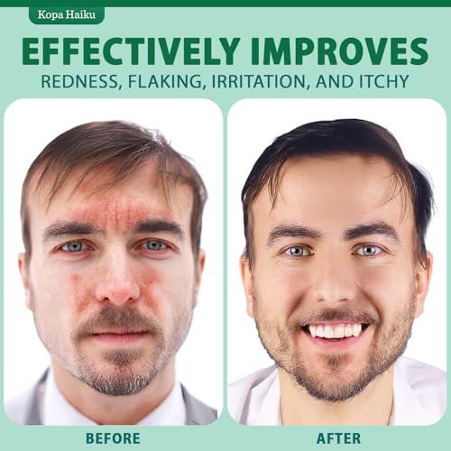 Seborrheic Dermatitis Face Cream | Natural Moisturizer for Sensitive Skin