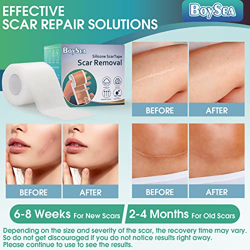 Boysea Silicone Scar Sheets (1.6" x 120") Clear Silicone Scar Tape - Scars Removal Treatment - Reusable Scar Strips for Keloid, C-Section, Burn, Surgical Scars