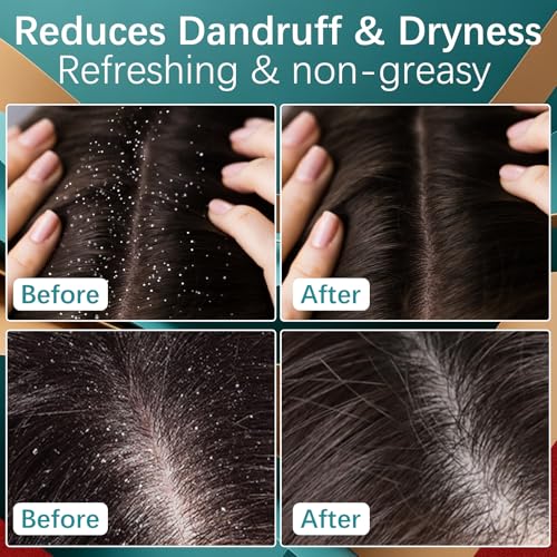 5% Minoxidil Hair Growth Cream for Men & Women - Anti Hair Loss Treatment with Biotin