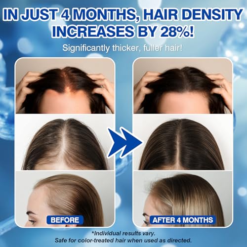 5% Minoxidil Spray for Women Hair Growth - 3 Pack