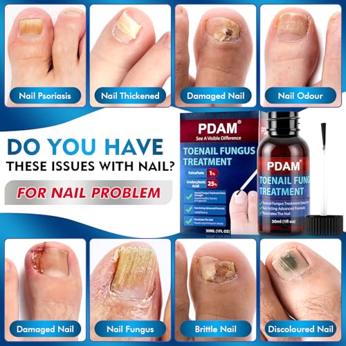 Toenail Fungus Treatment - 25% Undecylenic Acid Maximum Strength