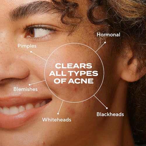 Murad Biome-Balancing Acne Treatment ? Salicylic, Mandelic, and Glutamic Acid Serum for Clearing and Preventing Breakouts, Decongesting Pores, and Balancing Skin Microbiome ? 1.0 Fl Oz
