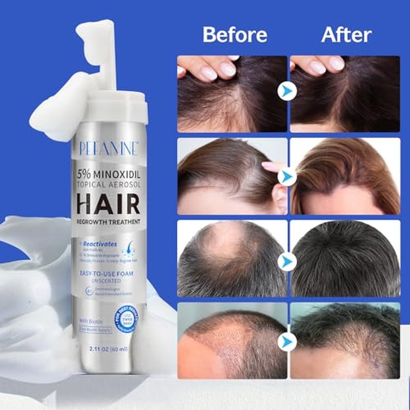 5% Minoxidil Hair Growth Foam for Men & Women