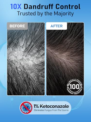 Ketoconazole Anti Dandruff Shampoo 1% - Maximum Strength Formula