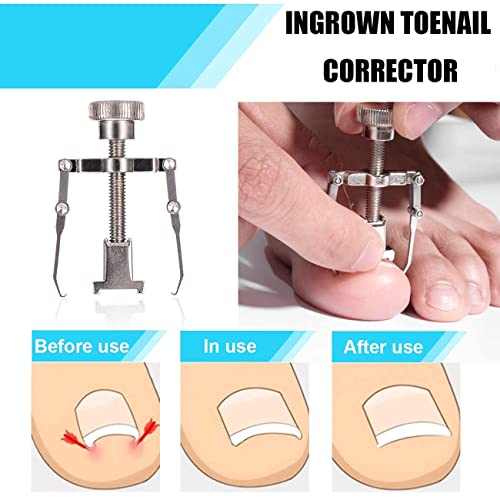 Ingrown Toenail Tool Kit (9PCS), Professional Toe Nail Clipper Set for Ingrown & Thick Nail, Stainless Steel Ingrown Toenail Kit, Surgery Grade Manicure Pedicure Tool by Dualeco