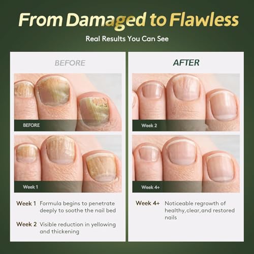 Toenail Fungus Treatment Liquid - Extra Strength Tea Tree Oil