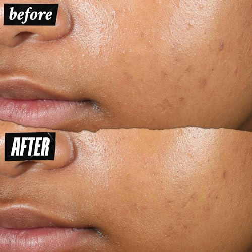 Kiehl's Truly Targeted Acne-Clearing Pimple Patch with 2% Salicylic Acid, Invisible Liquid Spot Treatment, 4% Niacinamide Fades Post-Acne Marks, 0.2% Licorice Root Soothes Redness - 0.5 fl oz