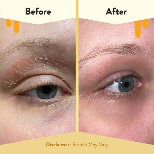 ECZEMA HONEY Multi Peptide Eye Cream - Anti Aging Eye Cream for Dark Circles & Puffiness - Facial Skin Care Products for Eczema, Dry & Sensitive Skin (0.5 Oz) (Pack of 2)