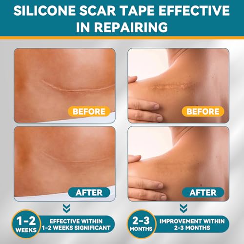 Silicone Scar Tape for Surgical Marks Face Stick Keloid Cover C-Section Strips Wrinkle Cream Lip Sleeping Gel Sheet Tummy Patch Hydrocolloid Roll Soft (3 Pack, 1.6"X 60")