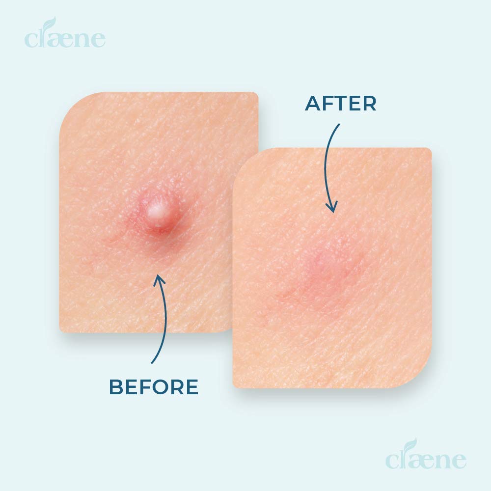 Claene Acne Pimple Concealing Patch - Invisible, Blemish Spot, Hydrocolloid, Skin Treatment, Facial Stickers, Absorbing Cover, 4 Sizes, Blends in with skin (28Patches)