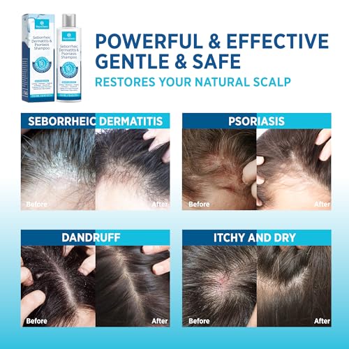 Roycederm Seborrheic Dermatitis & Psoriasis Face Cream ? Steroid-Free Moisturizer for Redness, Flaking & Sensitive Skin ? Face, Scalp & Body Daily Relief ? Fragrance-Free, Non-Greasy, 4 oz