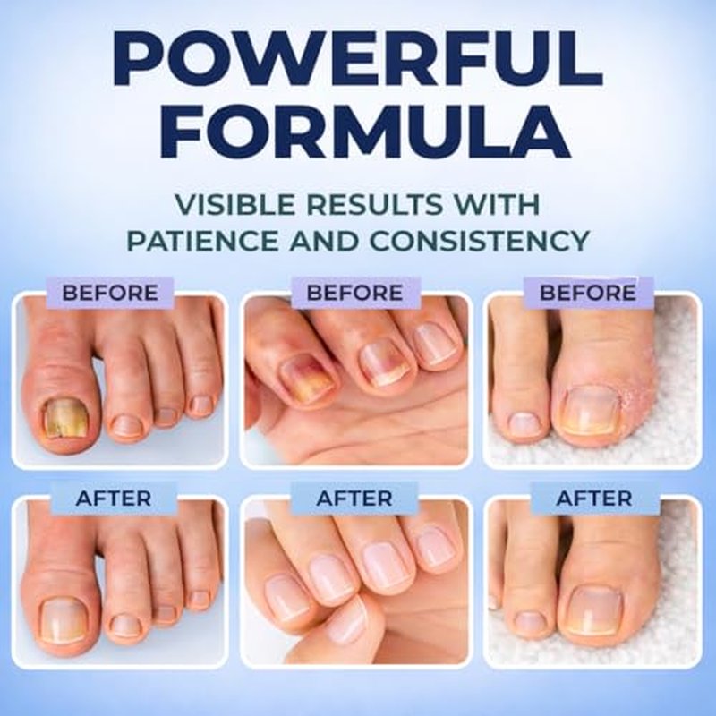Toenail Fungus Treatment Pen – 25% Undecylenic Acid FSA Eligible