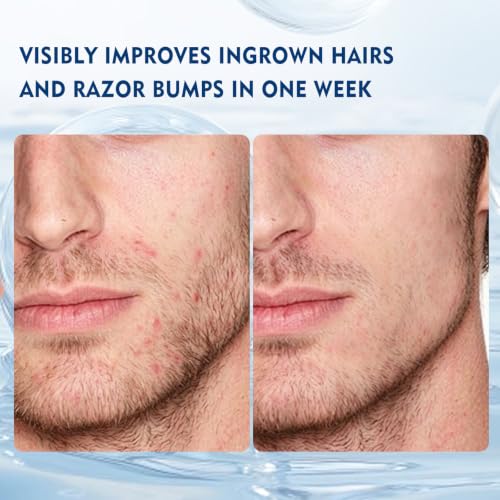 Bettenko Ingrown Hair Serum for Smooth, Clear Skin - Gentle & Fast-Absorbing