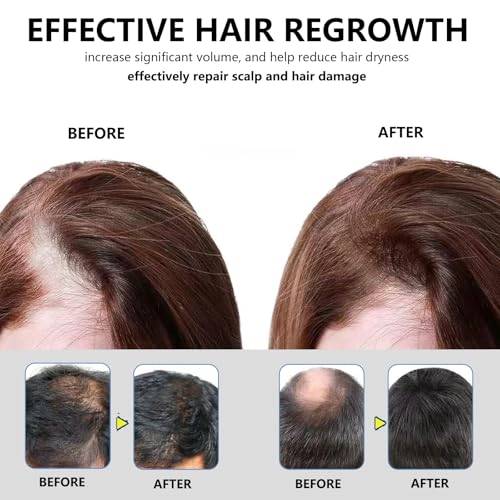 5% Hair Growth Scalp Massage Cream for Men & Women – Strengthens Roots, Promotes Regrowth