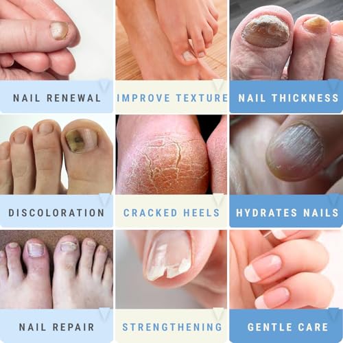 50% Urea Nail Gel Treatment for Thick, Damaged & Discolored Nails