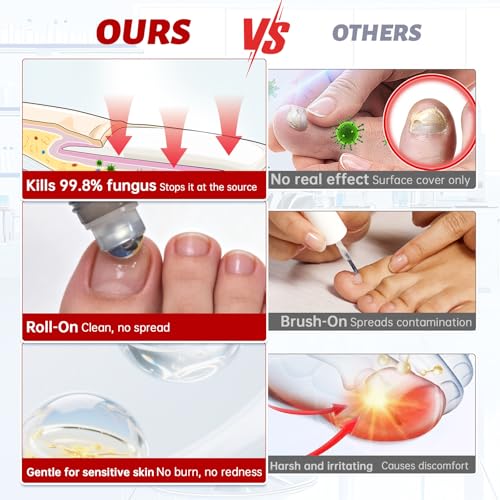 Tolnaftate 1% Antifungal Nail Treatment - Thick Discolored Nails
