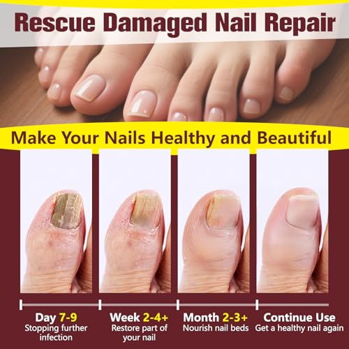 Toenail Fungus Treatment Extra Strength - 25% Undecylenic Acid