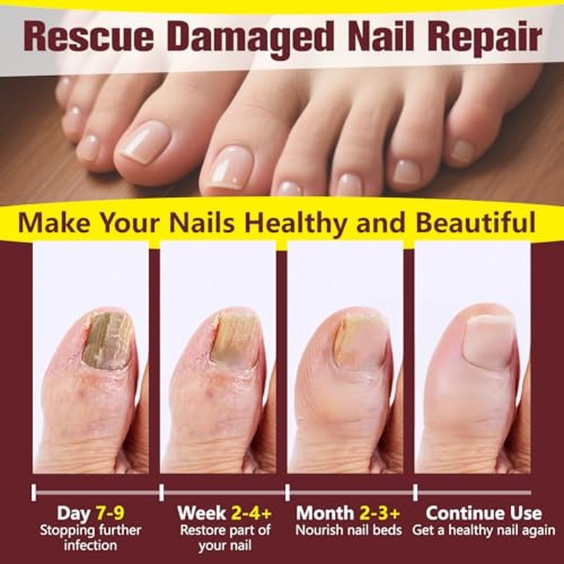 Extra Strength Toenail Fungus Treatment with 25% Undecylenic Acid