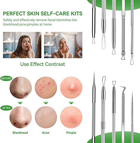 5-Piece Blackhead Remover Tool Kit - Pimple Popper Extractor Set