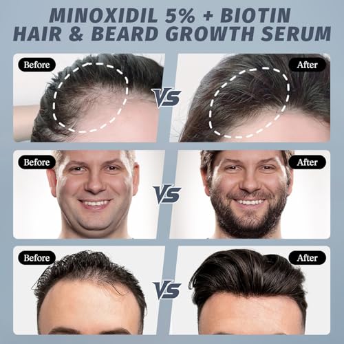 5% Minoxidil Spray for Hair Growth - Men & Women