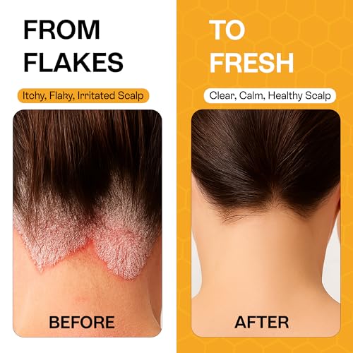 Pharmlitalia Psoriasis Shampoo with Salicylic Acid 3% – 6.76 Fl Oz (Pack of 2)