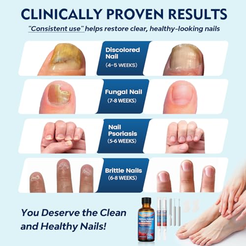 Kakalsa Extra Strength Toenail Fungus Treatment Kit with 25% Undecylenic Acid & Nail Repair Pens
