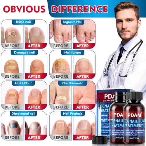 Toenail Care Solution with 25% Undecylenic Acid - 2 Pack