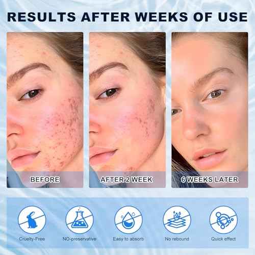 Azelaic Acid 10% Cream for Face - Acne Cream for Rosacea Reducing Relief Pimple Breakouts Blackhead Pigmentation and Redness - Azelaic Acid Gel For Facial and Skin Care