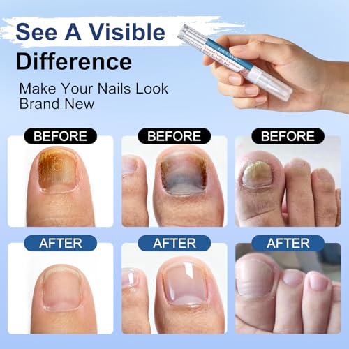 Toenail Fungus Treatment Pen 25% Undecylenic Acid - 6 Pack