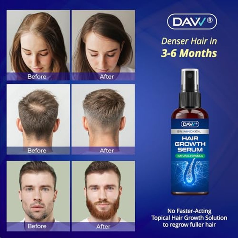 5% Minoxidil Hair Growth Spray for Women & Men - 2 Pack