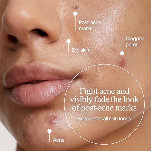 Neutrogena Evenly Clear Acne Gel Moisturizer with Salicylic Acid & N-Acetyl Glucosamine, Lightweight Non-Greasy Face Moisturizer Helps Treat Breakouts & Visibly Fade the look of Post-Acne, 1.7 fl. oz