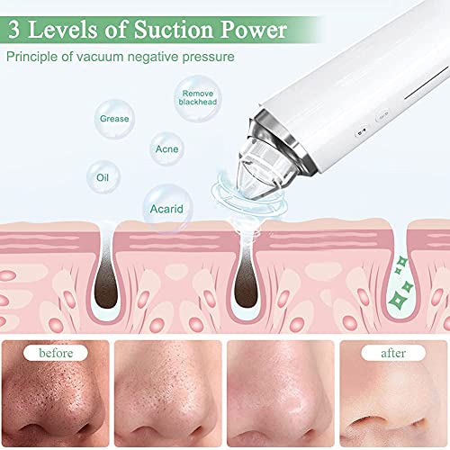 Blackhead Remover Pore Vacuum with 5MP Camera & 20X Magnification