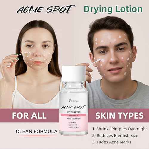 Premium Acne Spot Drying Lotion with Swab, Overnight Acne Treatment For Face, Dry Out Pimples, Blemishes, Zits And Clean Pores, 12ml / 0.41 FlOz