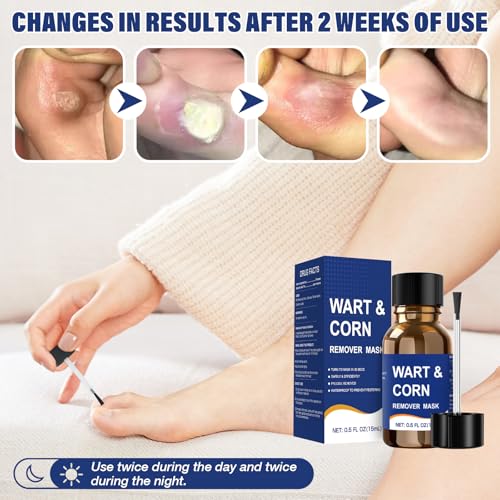 Mitreal Wart Remover Liquid with Salicylic Acid - Fast Acting for Warts, Corns & Calluses - 15ml