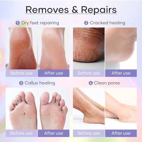 Lacqura Deluxe 6-Step Spa Pedicure Kit - Callus Remover Gel & Foot Scrub