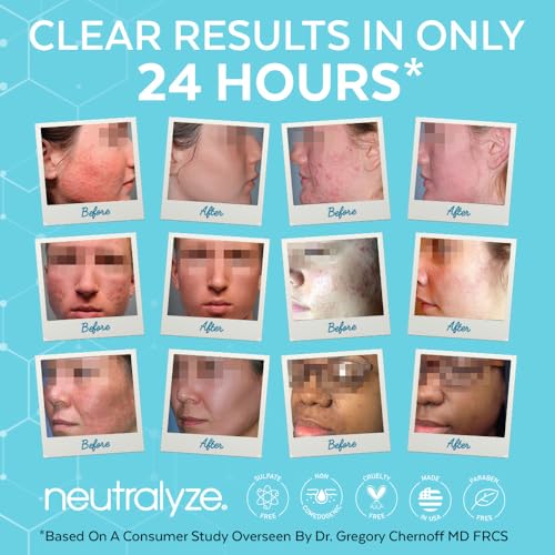 Neutralyze Moderate to Severe Acne Face Wash 2.0 - Maximum Strength 2% Mandelic Acid & 2% Salicylic Acid Facial Cleanser for Acne Prone Skin - Suitable for All Skin Types, Teens & Adults (5 FL OZ)