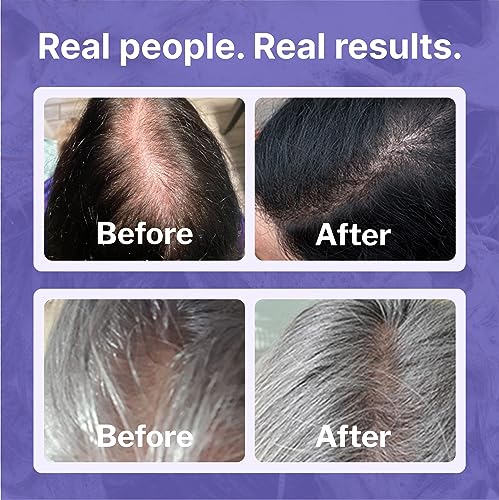 Shapiro MD Women's Hair Regrowth Kit with 2% Minoxidil