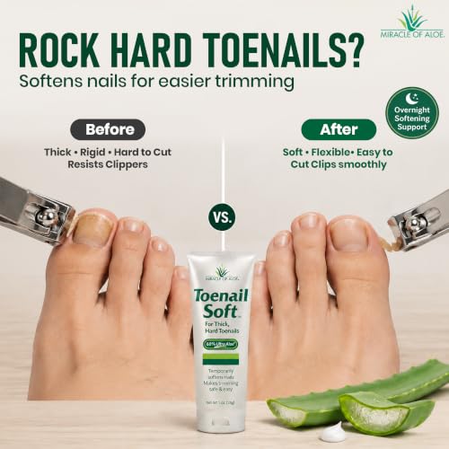 Miracle of Aloe Toenail Softener Cream for Thick Hard Nails - 1 oz