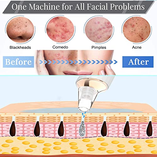 Upgraded Blackhead Remover Pore Vacuum with 3 Probes & 3 Suction Levels