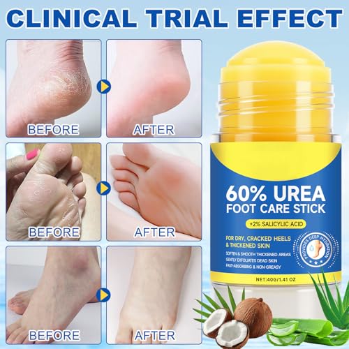 60% Urea Foot Cream Stick with 2% Salicylic Acid for Dry Cracked Feet (2 Pack)